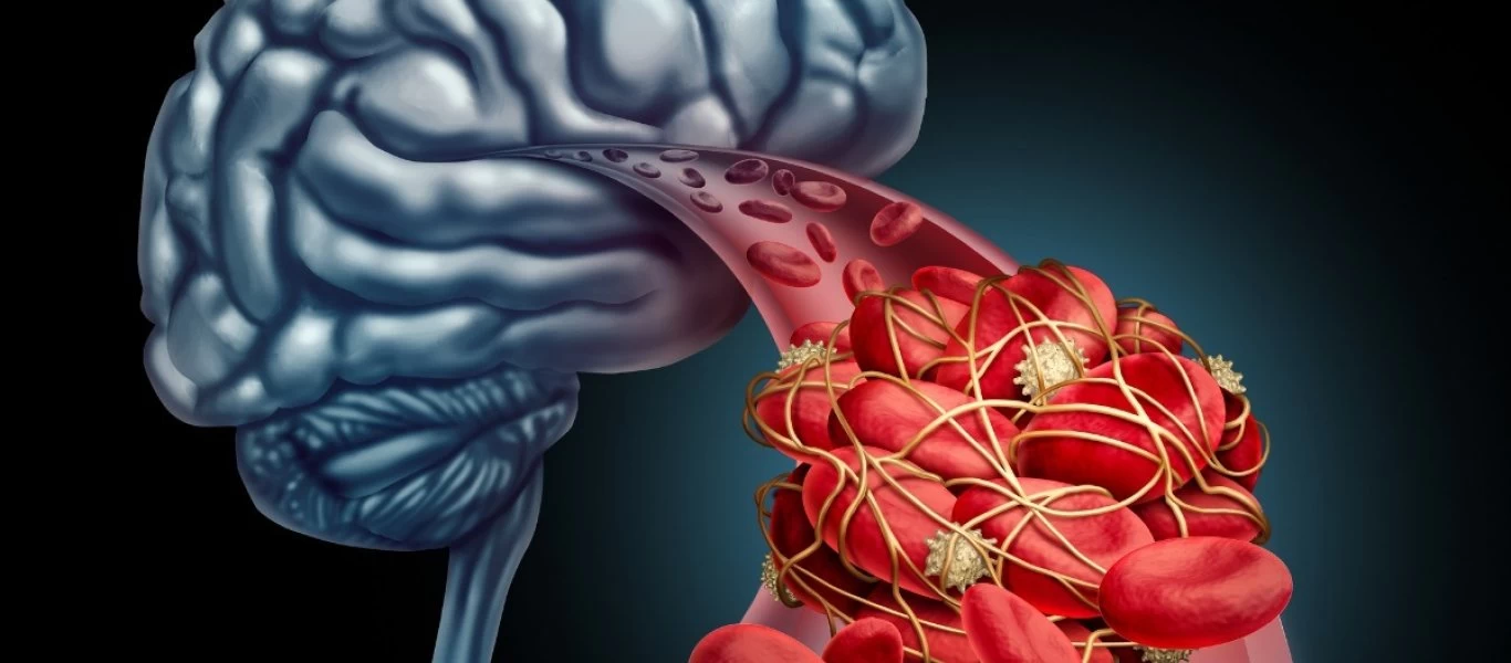 Ανεύρυσμα & υψηλή αρτηριακή πίεση: Δείτε τις 6 κυριότερες αιτίες ρήξης